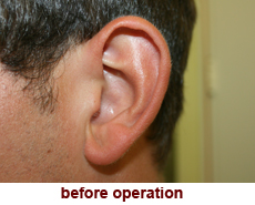 plastic-surgery-prominent-ear 